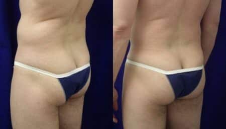 patient-12382-gluteal-augmentation-before-after