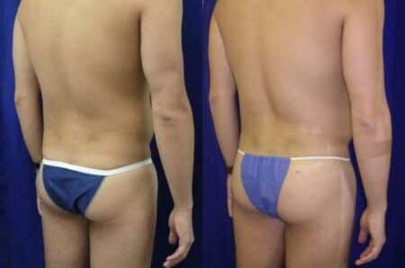 patient-12387-gluteal-augmentation-before-after