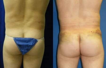 patient-12390-gluteal-augmentation-before-after-1