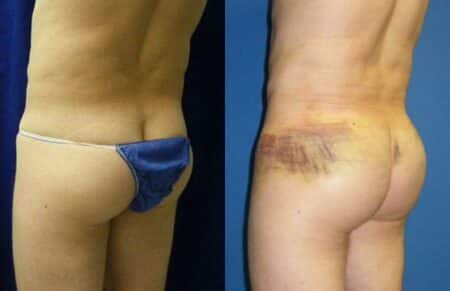 patient-12390-gluteal-augmentation-before-after