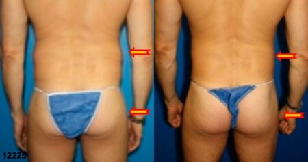 patient-12398-gluteal-augmentation-before-after-1