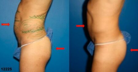 patient-12398-gluteal-augmentation-before-after-3