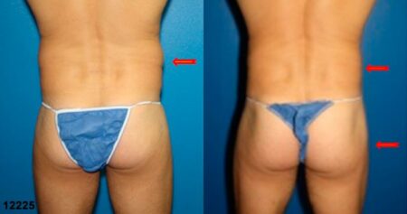 patient-12398-gluteal-augmentation-before-after