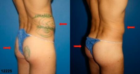 patient-12398-gluteal-augmentation-before-after-6