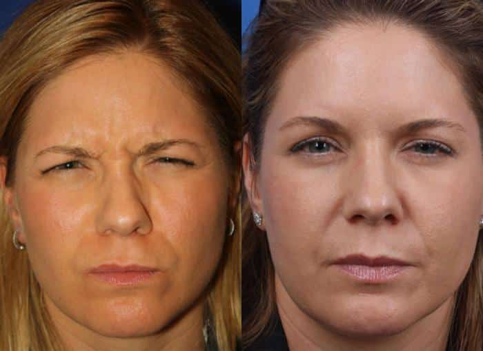 Botox injections to reduce glabellar (frown) lines in a female patient. After injections area between the eyebrows is visibly smoother with fewer lines and wrinkles.