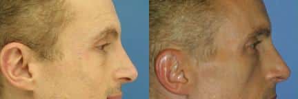 patient-12419-wrinkle-treatments-before-after-1