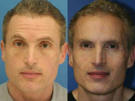 Botox injections to treat forehead wrinkles in a male patient. After injections forehead is visibly smoother and line-free.