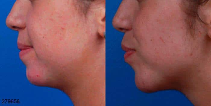 Botox injections to treat smile lines in a female patient. After injections, lines between the nose and mouth are visibly reduced.