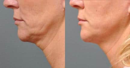 Ultherapy to tighten skin below the chin and on the neck of a female patient by Dr. Miller. Treatment firms the skin underneath the jawline and creates a smoother contour from the chin to the neck.