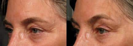 Ultherapy to tighten skin around the eyes of a female patient by Dr. Miller. After treatment, patient's skin is smoother with fewer lines and wrinkles.