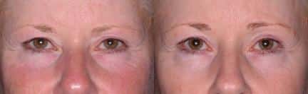 Ultherapy to tighten and firm skin around the eyes of a female patient by Dr. Miller. Treatment smooths the skin and visibly reduces lines and wrinkles.