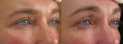 Ultherapy to tighten and firm skin around the eyes of a female patient by Dr. Miller. Treatment creates smoother skin with visible reduction in wrinkles.