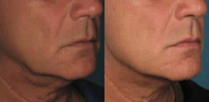 Ultherapy to treat early jowl formation on the jawline of a male patient by Dr. Miller. After Ultherapy session, skin is firmer and there is better definition along the jawline.