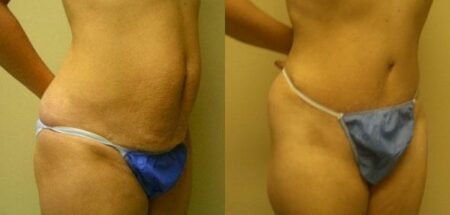 patient-12458-tummy-tuck-abdominoplasty-before-after-1