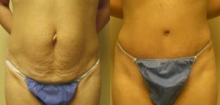 patient-12458-tummy-tuck-abdominoplasty-before-after