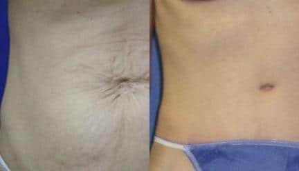 patient-12463-tummy-tuck-abdominoplasty-before-after-1