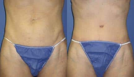 patient-12463-tummy-tuck-abdominoplasty-before-after