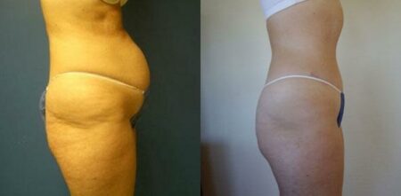 patient-12477-tummy-tuck-abdominoplasty-before-after