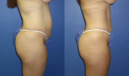 patient-12480-tummy-tuck-abdominoplasty-before-after-1