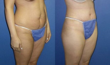 patient-12480-tummy-tuck-abdominoplasty-before-after