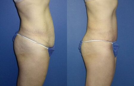 patient-12485-tummy-tuck-abdominoplasty-before-after