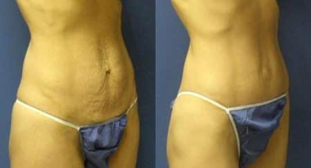 patient-12507-tummy-tuck-abdominoplasty-before-after-1