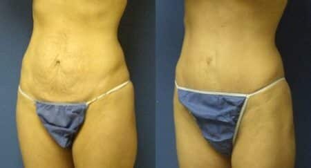 patient-12507-tummy-tuck-abdominoplasty-before-after-2