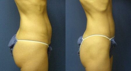 patient-12507-tummy-tuck-abdominoplasty-before-after-3