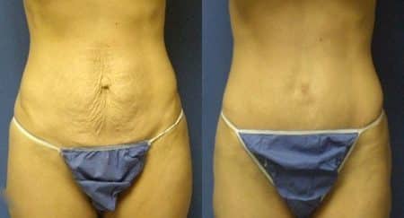 patient-12507-tummy-tuck-abdominoplasty-before-after