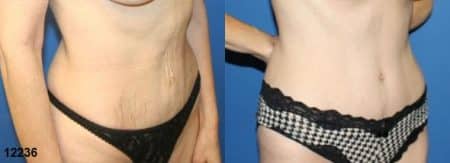 patient-12534-tummy-tuck-abdominoplasty-before-after-1