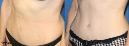 patient-12534-tummy-tuck-abdominoplasty-before-after-2