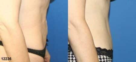 patient-12534-tummy-tuck-abdominoplasty-before-after-3