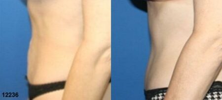 patient-12534-tummy-tuck-abdominoplasty-before-after-4