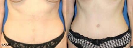 patient-12534-tummy-tuck-abdominoplasty-before-after