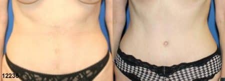 patient-12534-tummy-tuck-abdominoplasty-before-after