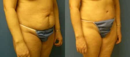 patient-12552-tummy-tuck-revision-before-after-1