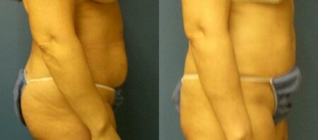 patient-12552-tummy-tuck-revision-before-after-2