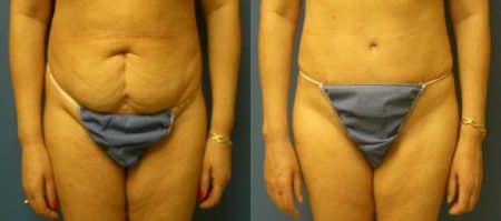 patient-12552-tummy-tuck-revision-before-after