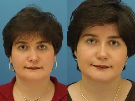 Rhinoplasty to correct asymmetry left behind by fracture on a female patient by Dr. Miller. After surgery, nose is straighter and shape is improved.