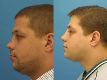 Nasal fracture repair on a male patient by Dr. Miller. Procedure creates more aesthetically pleasing nasal bridge.
