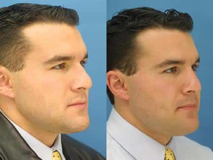 Nasal fracture repair on a male patient by Dr. Miller. Surgery leaves nos straighter and refines tip.