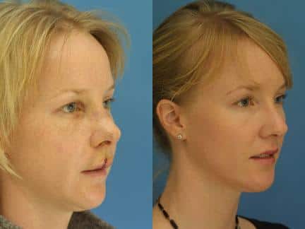patient-12571-nasal-fracture-repair-before-after-1