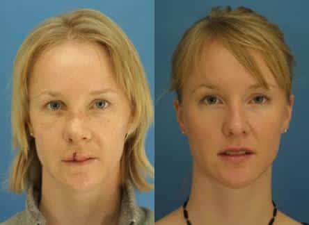 Nasal fracture repair on a female patient by Dr. Miller. Surgery straightens nasal bridge and refines tip.