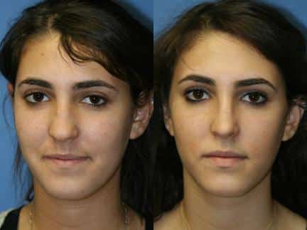 Revision rhinoplasty to correct nasal bridge and tip on a female patient by Dr. Miller. After surgery, nasal bridge is straighter and tip is more refined.