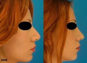 Revision rhinoplasty to correct nasal bridge and tip on a female patient by Dr. Miller. Surgery creates straighter nasal bridge and refines the tip for a more aesthetically pleasing facial profile.