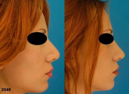 patient-12587-revision-rhinoplasty-before-after-1