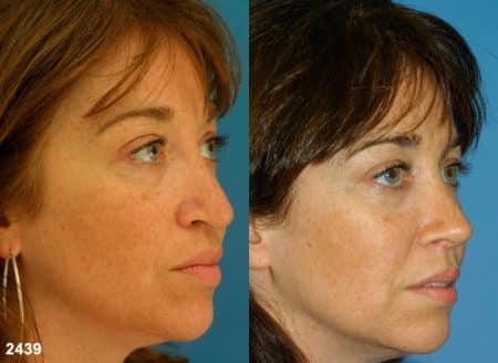 patient-12592-revision-rhinoplasty-before-after-1