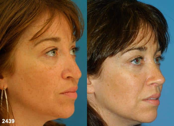Revision rhinoplasty to correct nasal bridge and tip on a female patient by Dr. Miller. Procedure produces straighter nasal bridge and rotates and refines tip to improve facial profile.