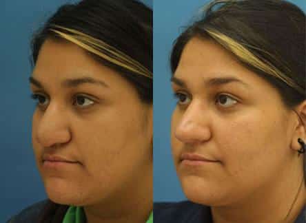 Revision rhinoplasty to correct nasal tip on a female patient. Tip is rotated and refined to create a more aesthetically pleasing facial profile.