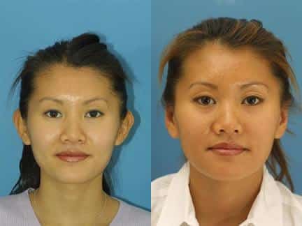 Otoplasty to correct the position of the ears. After surgery, ears are closer to the sides of the head for a more attractive facial contour.
